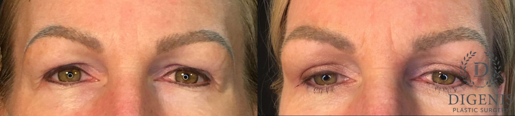 Before and after Eye Lid Surgery case 35145
