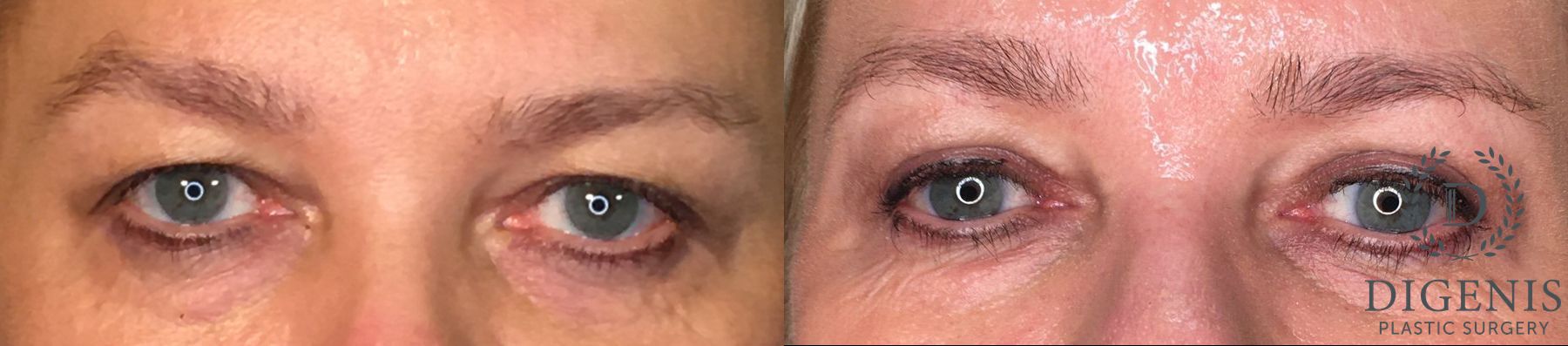 Before and after Eyelid Surgery case 35161