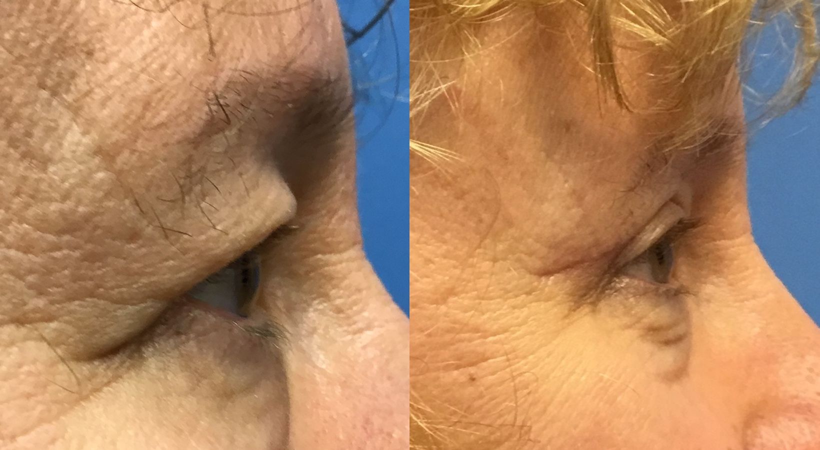 Before and after Eyelid Surgery case 35092 - Angle 3
