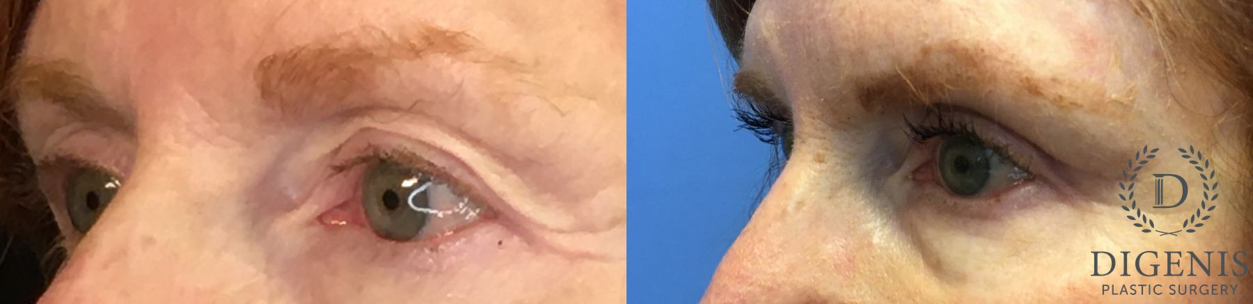 Before and after Eye Lid Surgery case 35153 - Angle 4