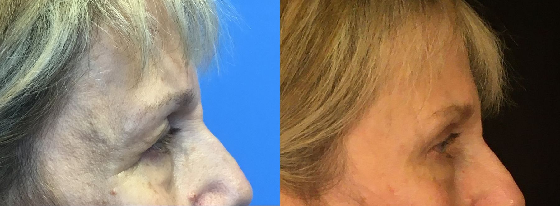 Before and after Eyelid Surgery case 35109 - Angle 3