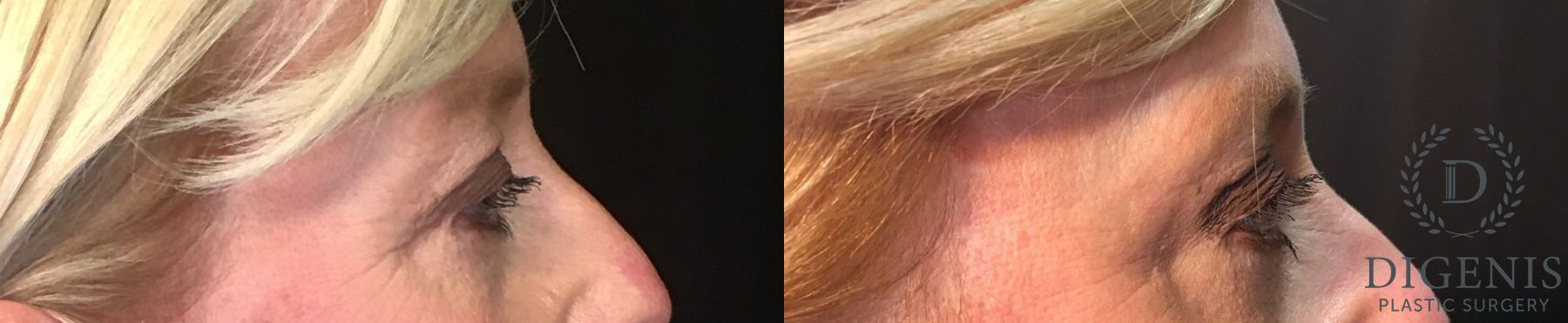 Before and after Eye Lid Surgery case 35154 - Angle 3