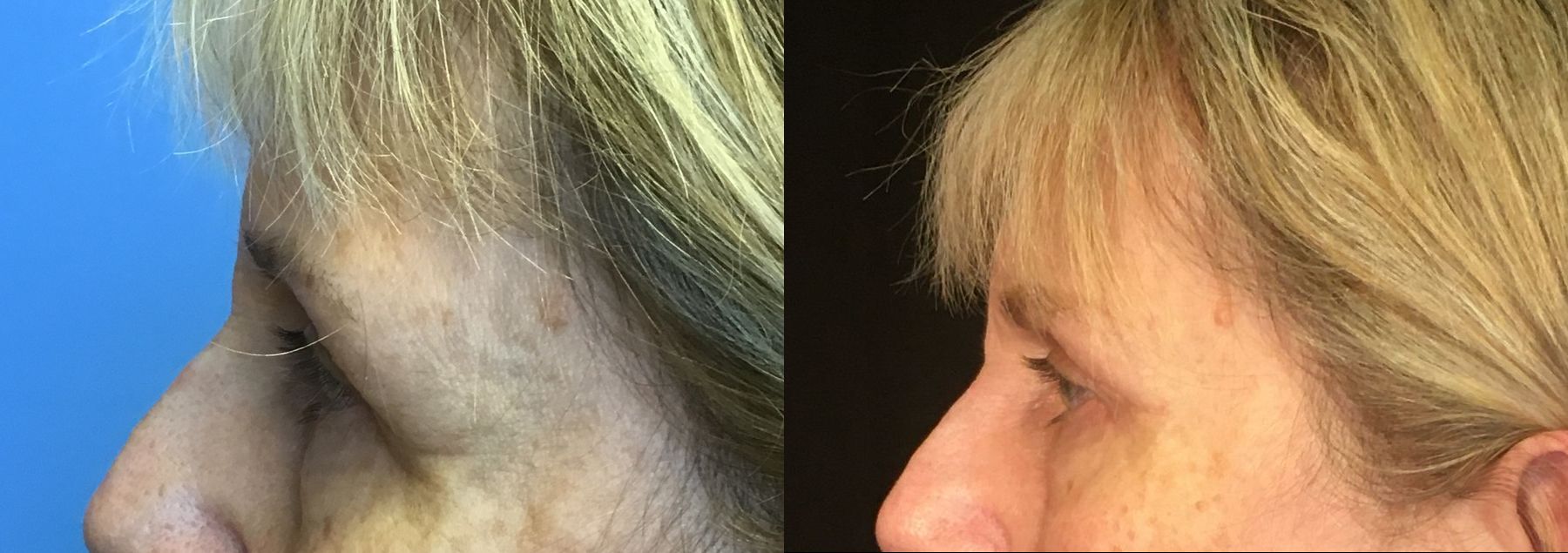 Before and after Eyelid Surgery case 35109 - Angle 5
