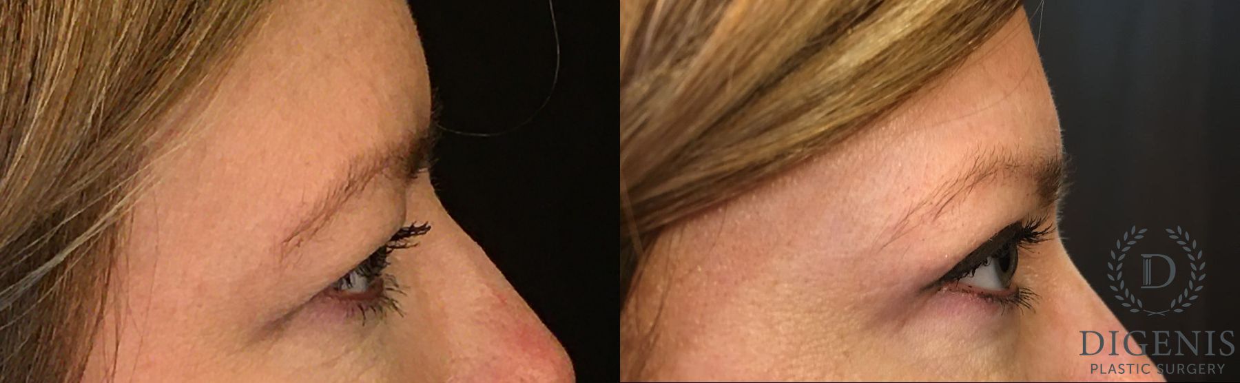 Before and after Eyelid Surgery case 35129 - Angle 2