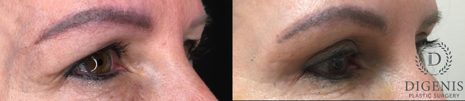 Before and after Eye Lid Surgery case 35179 - Angle 2