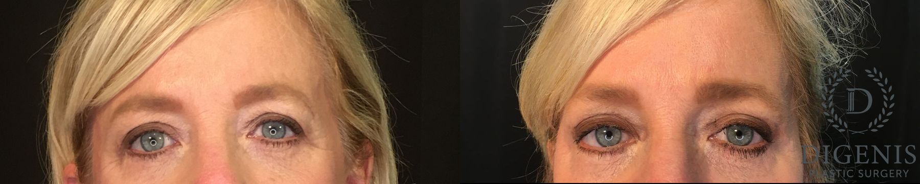 Before and after Eye Lid Surgery case 35154