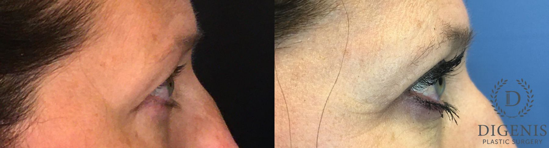 Before and after Eye Lid Surgery case 35147 - Angle 3