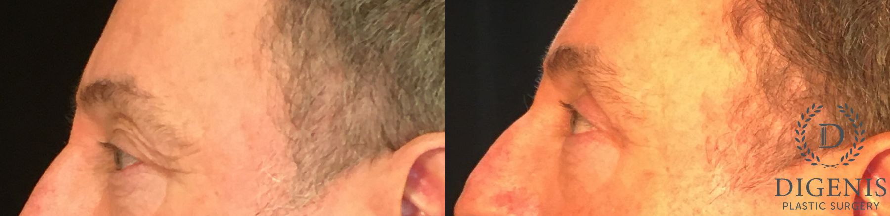 Before and after Eyelid Surgery case 35029 - Angle 5