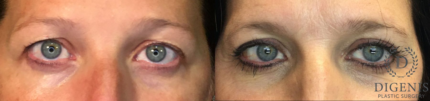 Before and after Eye Lid Surgery case 35147