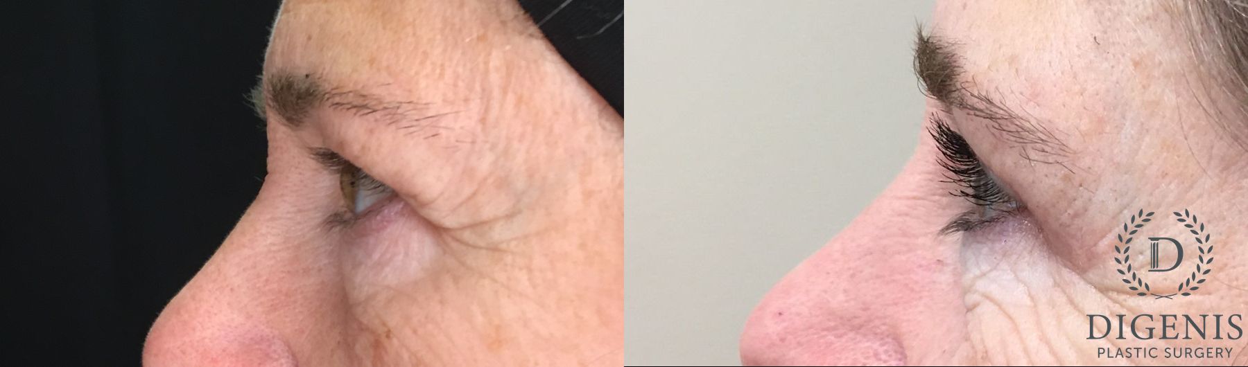 Before and after Eye Lid Surgery case 35204 - Angle 5