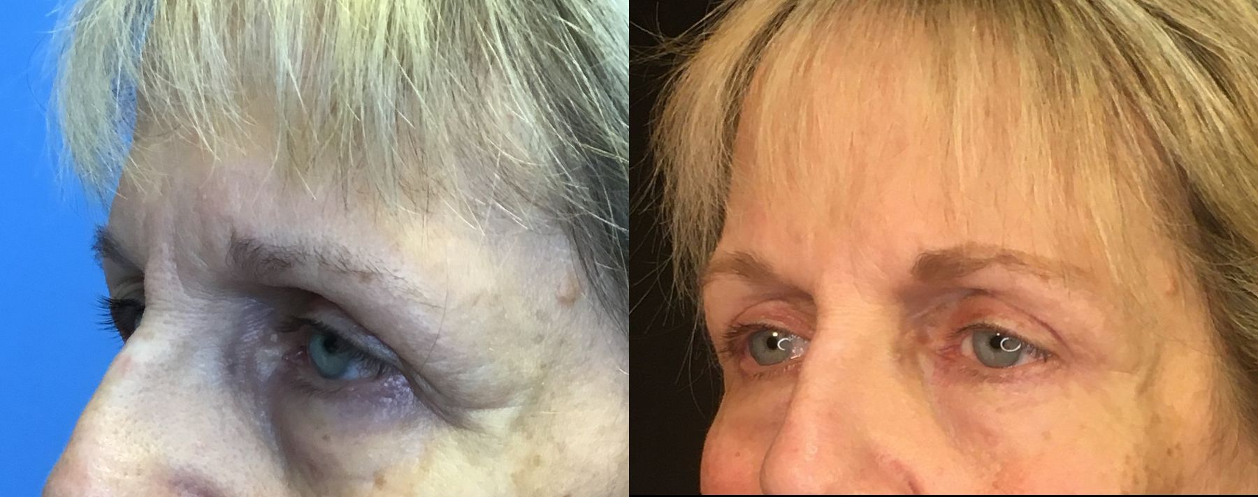 Before and after Eyelid Surgery case 35109 - Angle 4