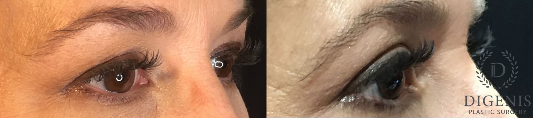 Before and after Eye Lid Surgery case 35189 - Angle 2