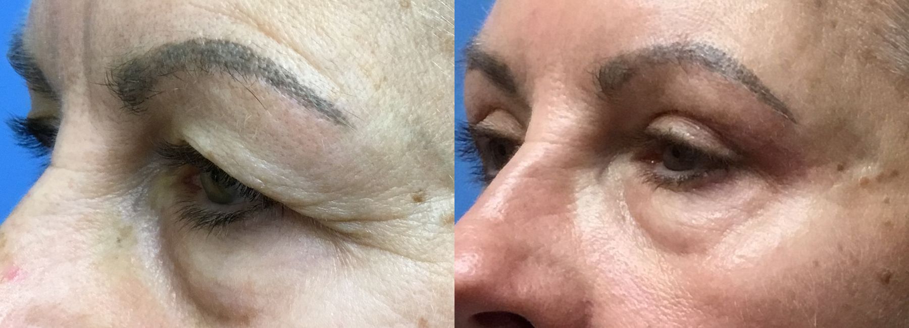 Before and after Eye Lid Surgery case 35112 - Angle 4