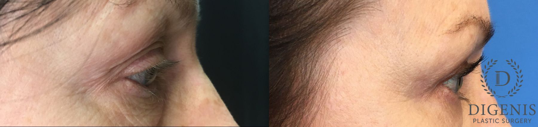 Before and after Eyelid Surgery case 35163 - Angle 3