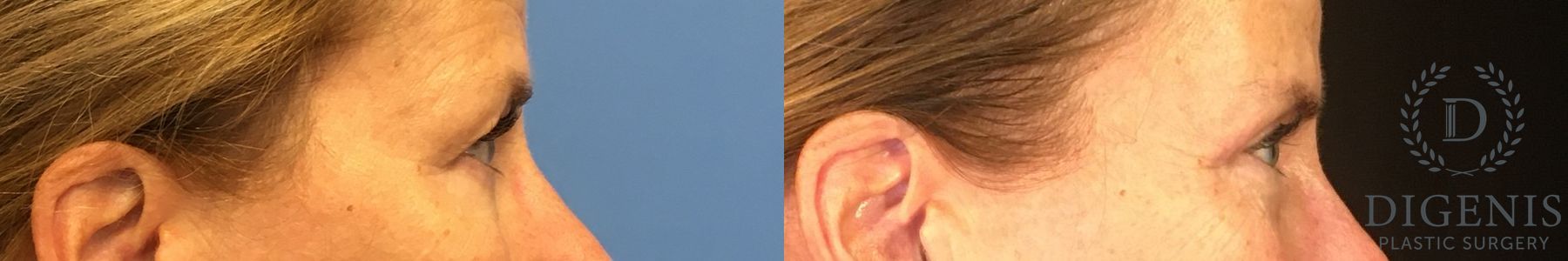 Before and after Eye Lid Surgery case 35059 - Angle 3