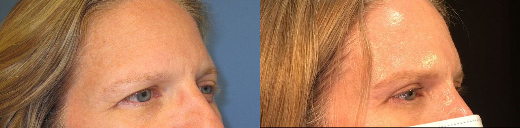 Before and after Eyelid Surgery case 35097 - Angle 2