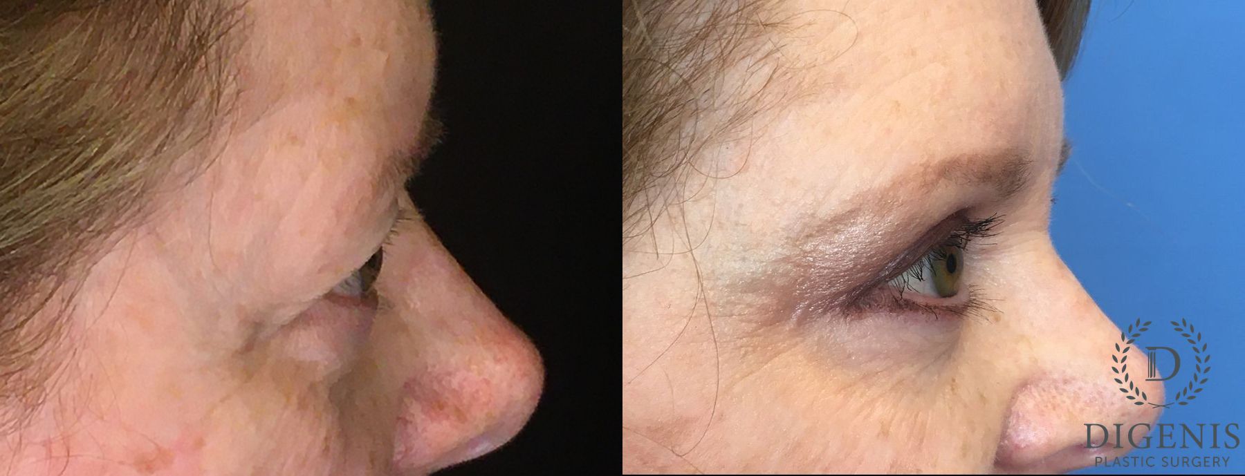 Before and after Eye Lid Surgery case 35146 - Angle 3