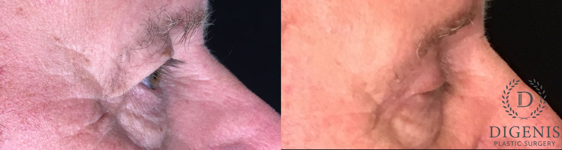 Before and after Eye Lid Surgery case 35183 - Angle 3