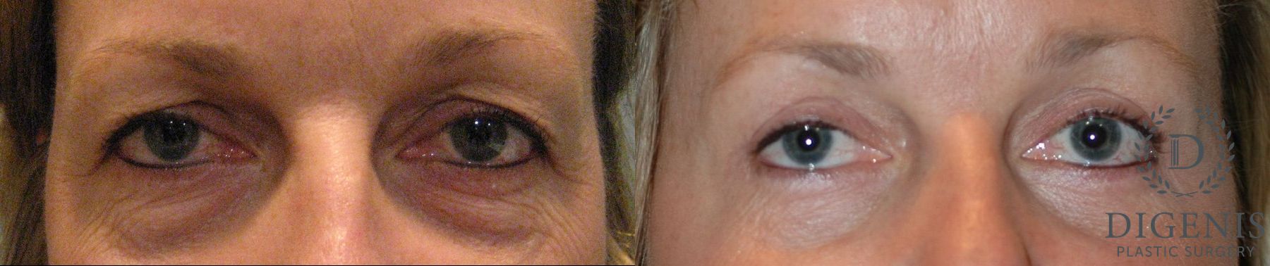 Before and after Eye Lid Surgery case 35101