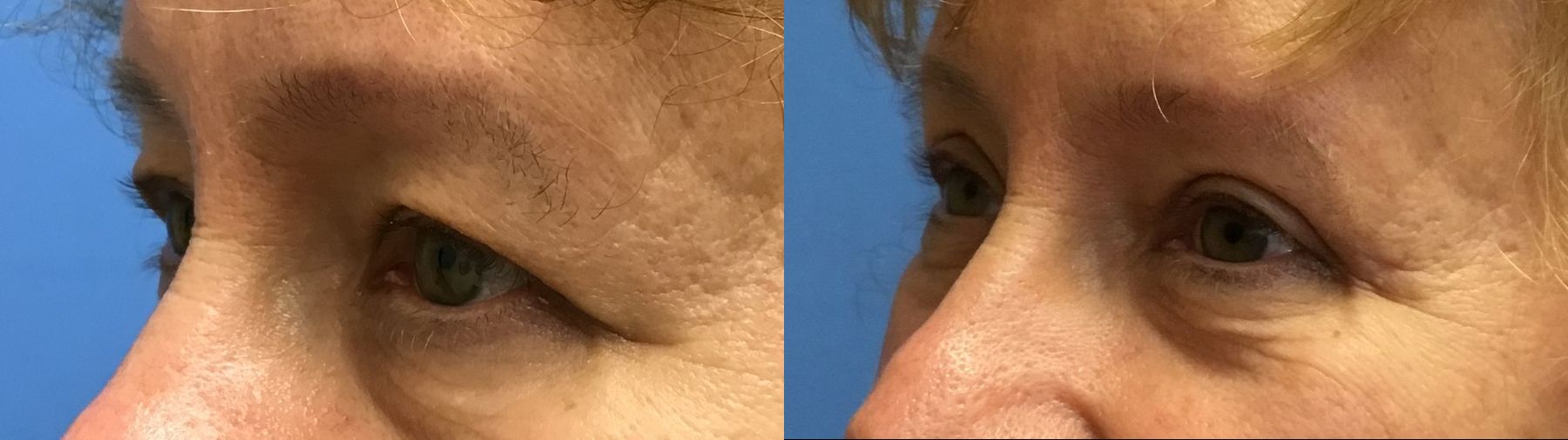 Before and after Eyelid Surgery case 35092 - Angle 4