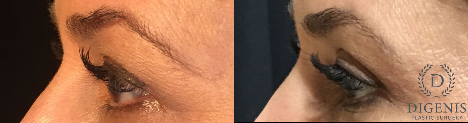 Before and after Eye Lid Surgery case 35189 - Angle 5