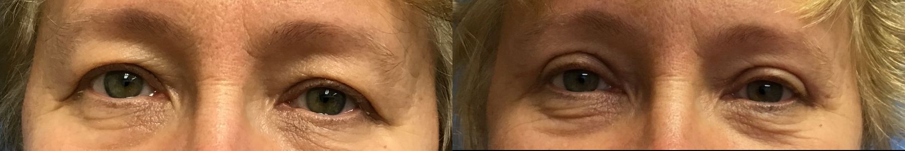 Before and after Eyelid Surgery case 35092