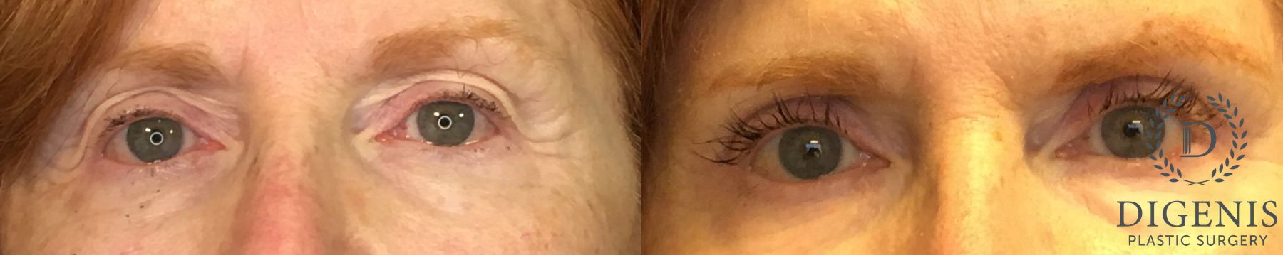 Before and after Eye Lid Surgery case 35153