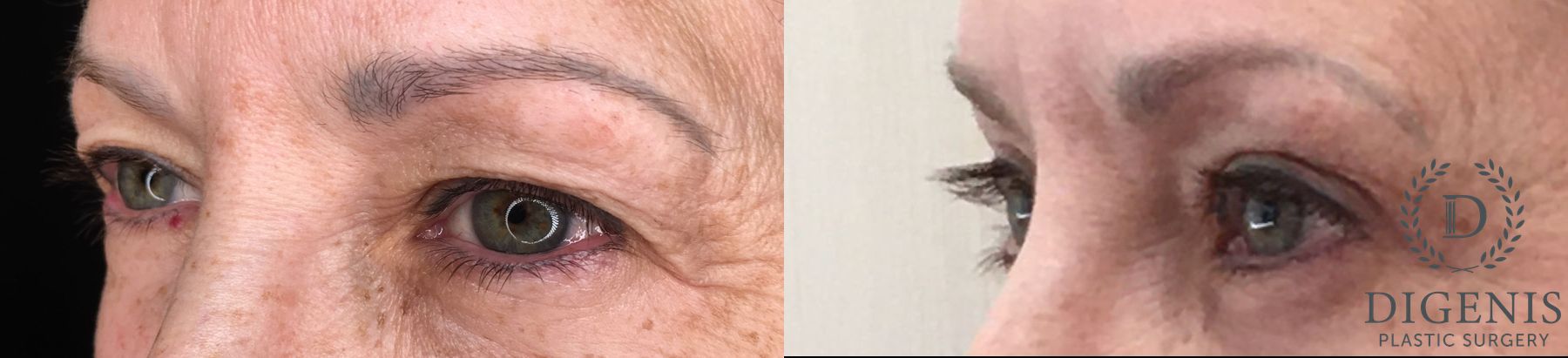 Before and after Eye Lid Surgery case 35190 - Angle 4