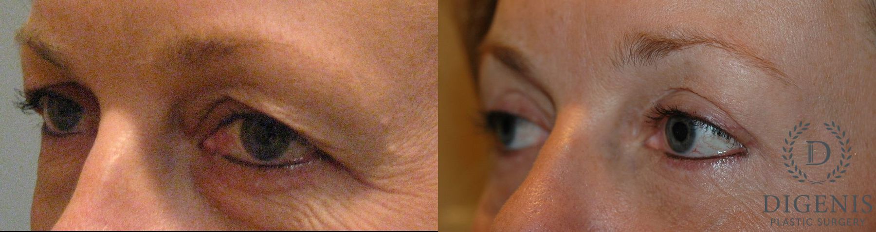 Before and after Eye Lid Surgery case 35101 - Angle 3