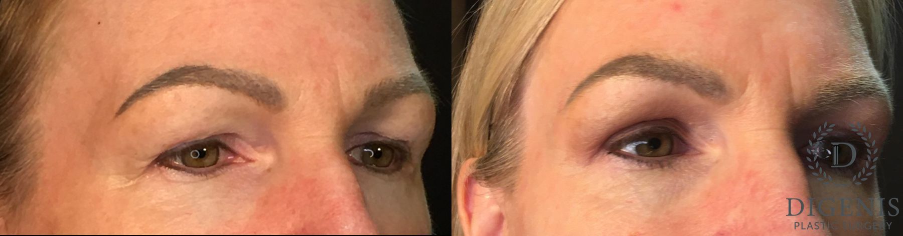 Before and after Eye Lid Surgery case 35145 - Angle 2