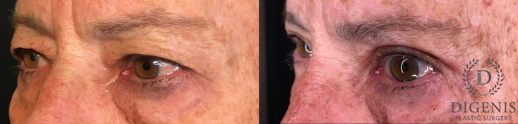 Before and after Eye Lid Surgery case 35193 - Angle 4