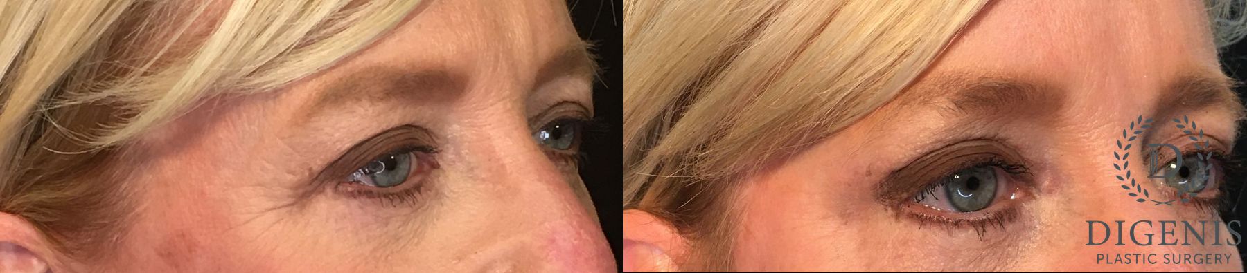 Before and after Eye Lid Surgery case 35154 - Angle 2