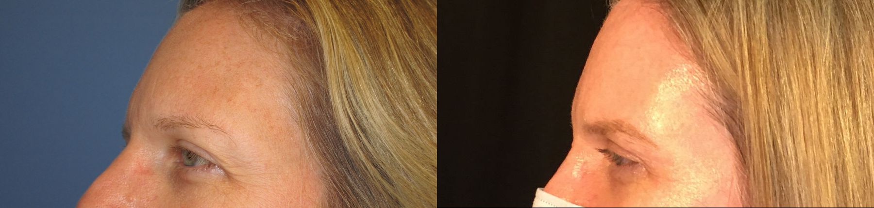 Before and after Eyelid Surgery case 35097 - Angle 3