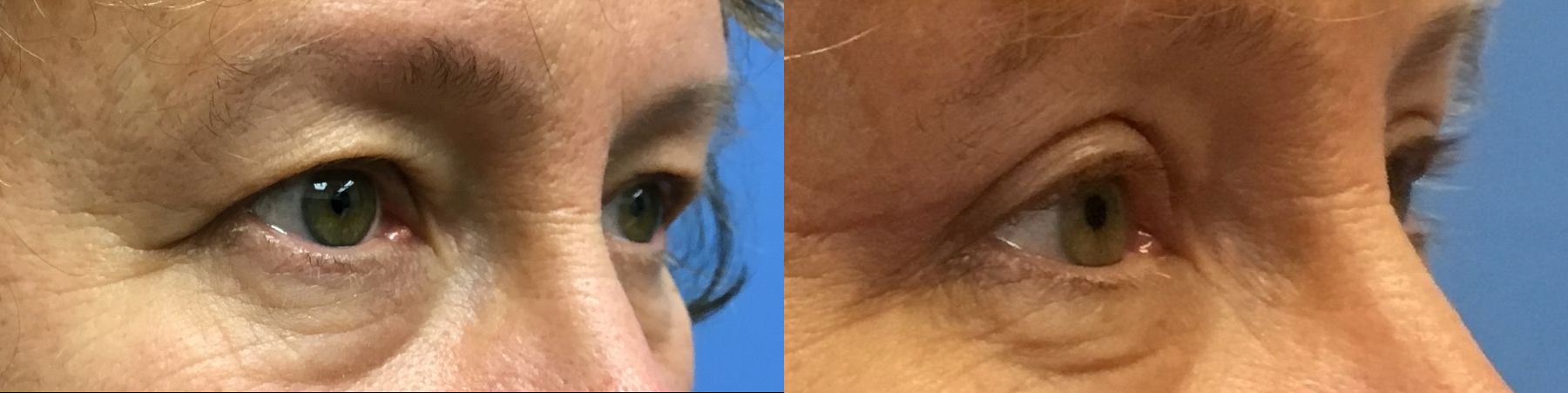 Before and after Eyelid Surgery case 35092 - Angle 2
