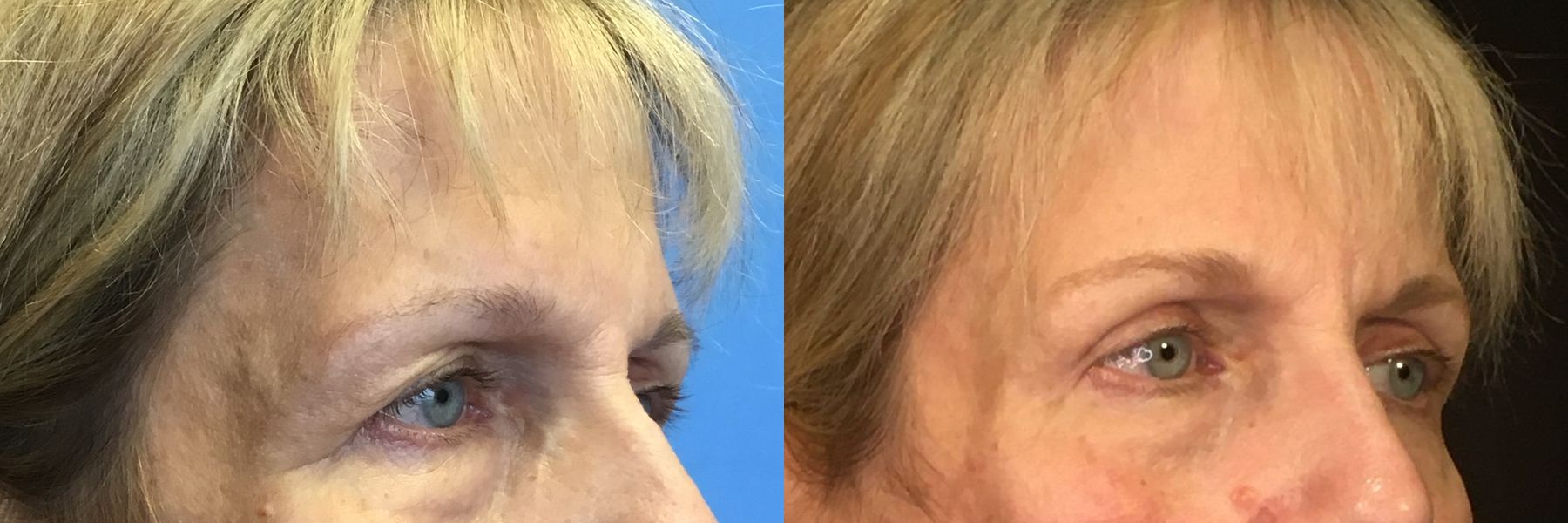 Before and after Eyelid Surgery case 35109 - Angle 2