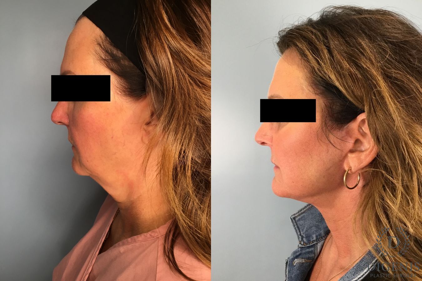 Before and after Face Lift/Neck Lift case 41696 - Angle 3