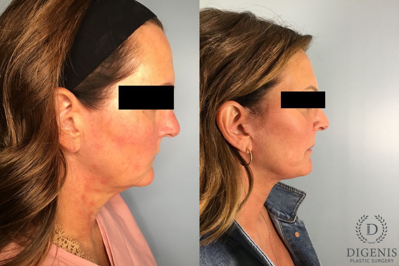 Before and after Face Lift/Neck Lift case 41696 - Angle 5