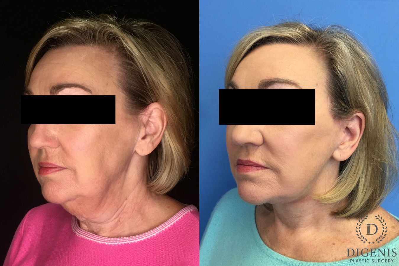 Before and after Face Lift/Neck Lift case 34969 - Angle 2