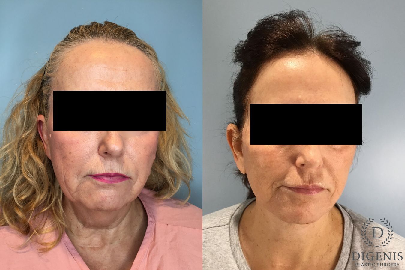 Before and after Face Lift/Neck Lift case 46141
