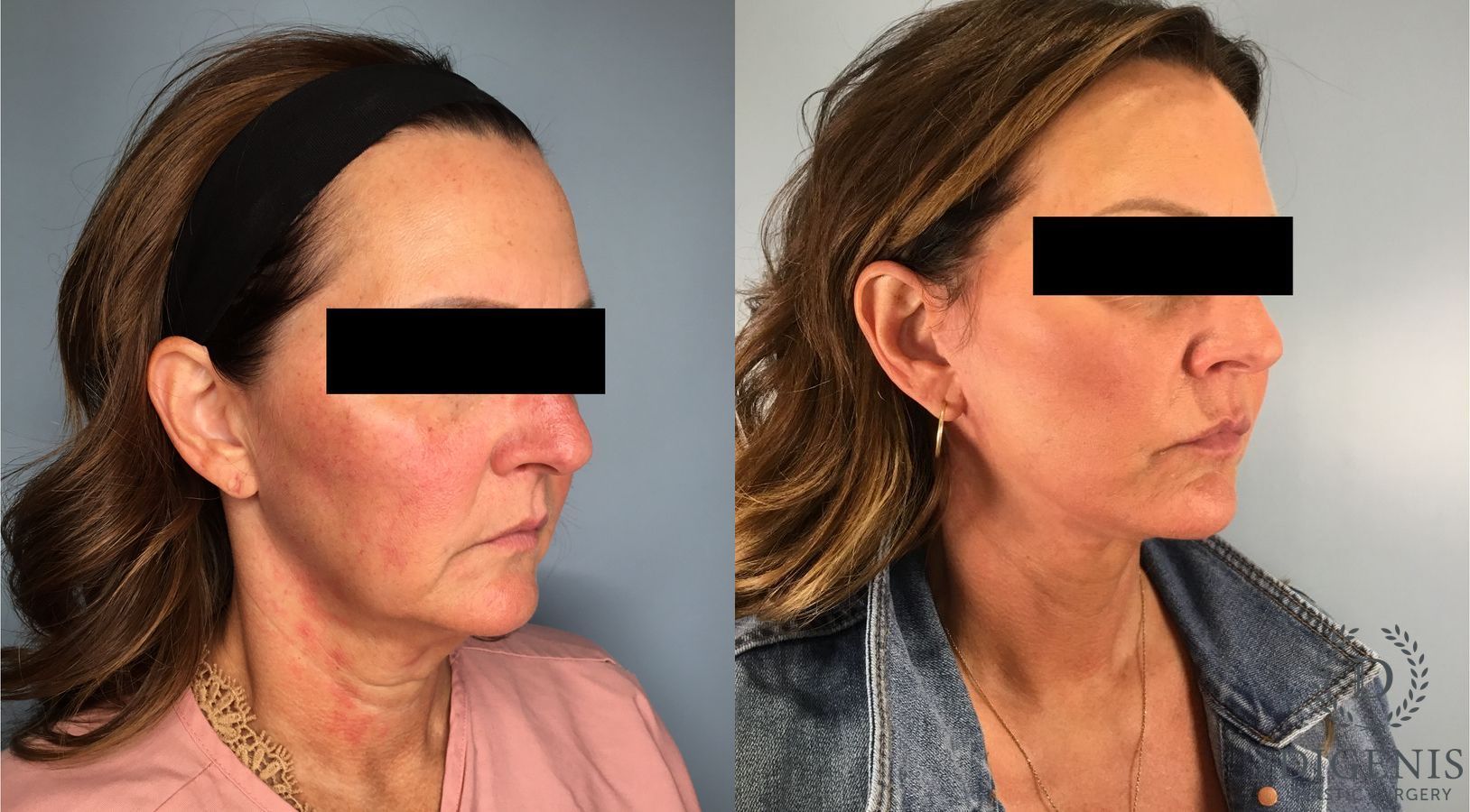 Before and after Face Lift/Neck Lift case 41696 - Angle 4