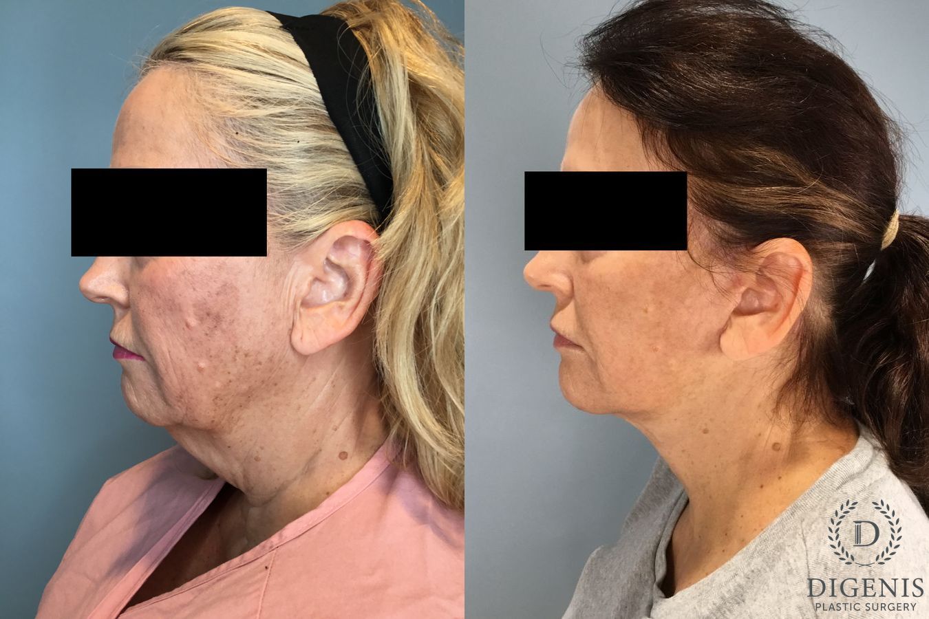 Before and after Face Lift/Neck Lift case 46141 - Angle 3