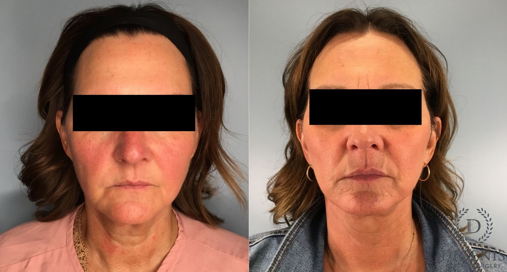 Before and after Face Lift/Neck Lift case 41696