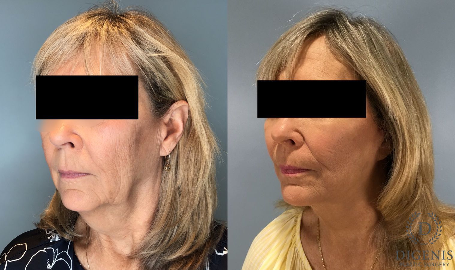 Before and after Face Lift/Neck Lift case 45832 - Angle 4