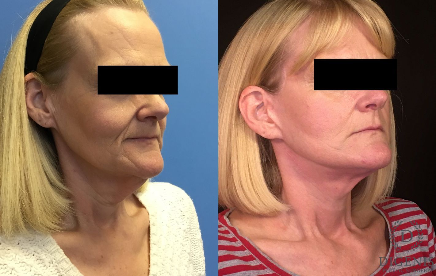 Before and after Face Lift/Neck Lift case 34964 - Angle 2