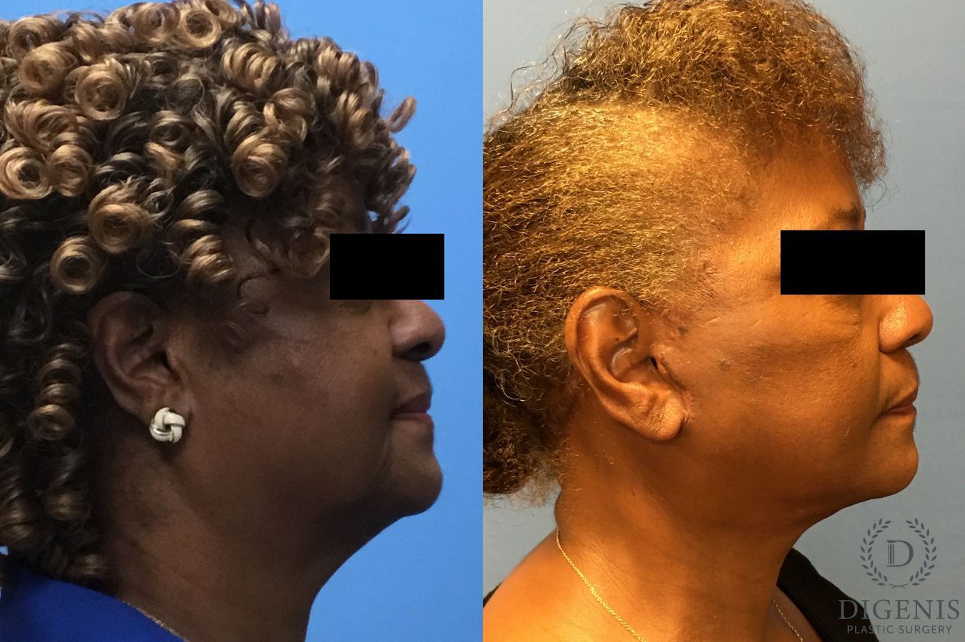 Before and after Face Lift/Neck Lift case 34959 - Angle 3