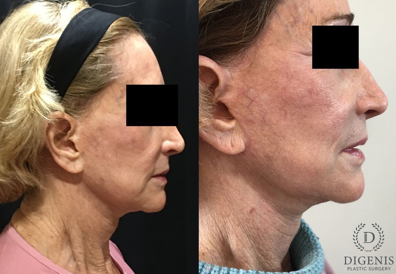 Before and after Face Lift/Neck Lift case 34985 - Angle 3