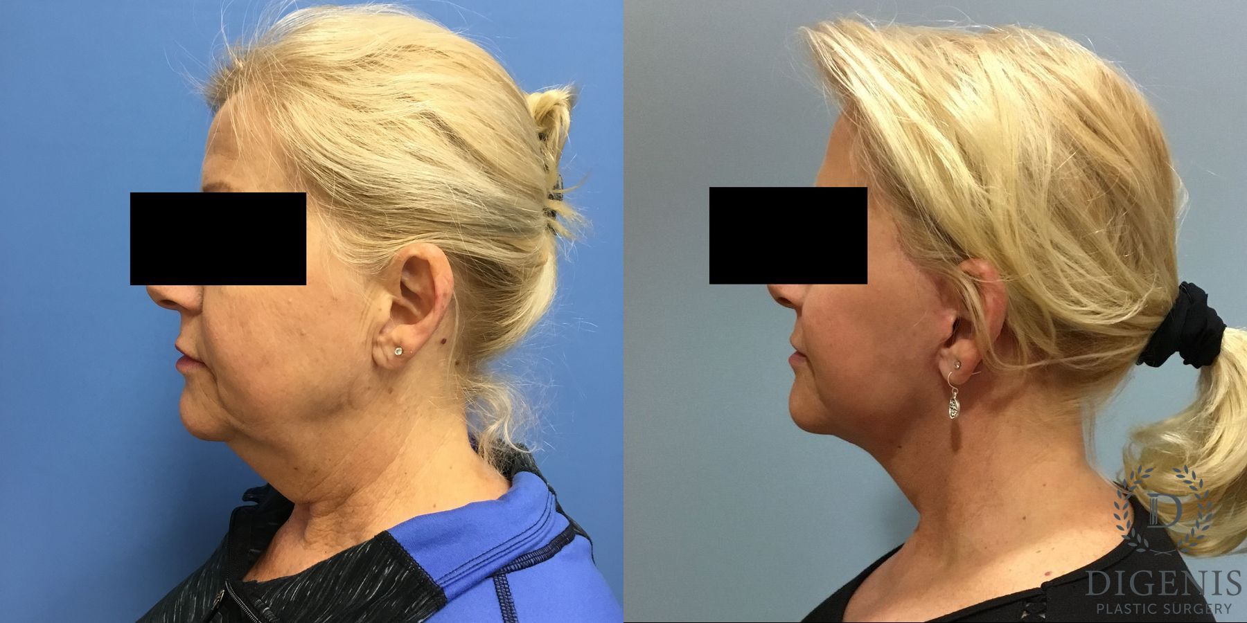 Before and after Face Lift/Neck Lift case 34961 - Angle 5