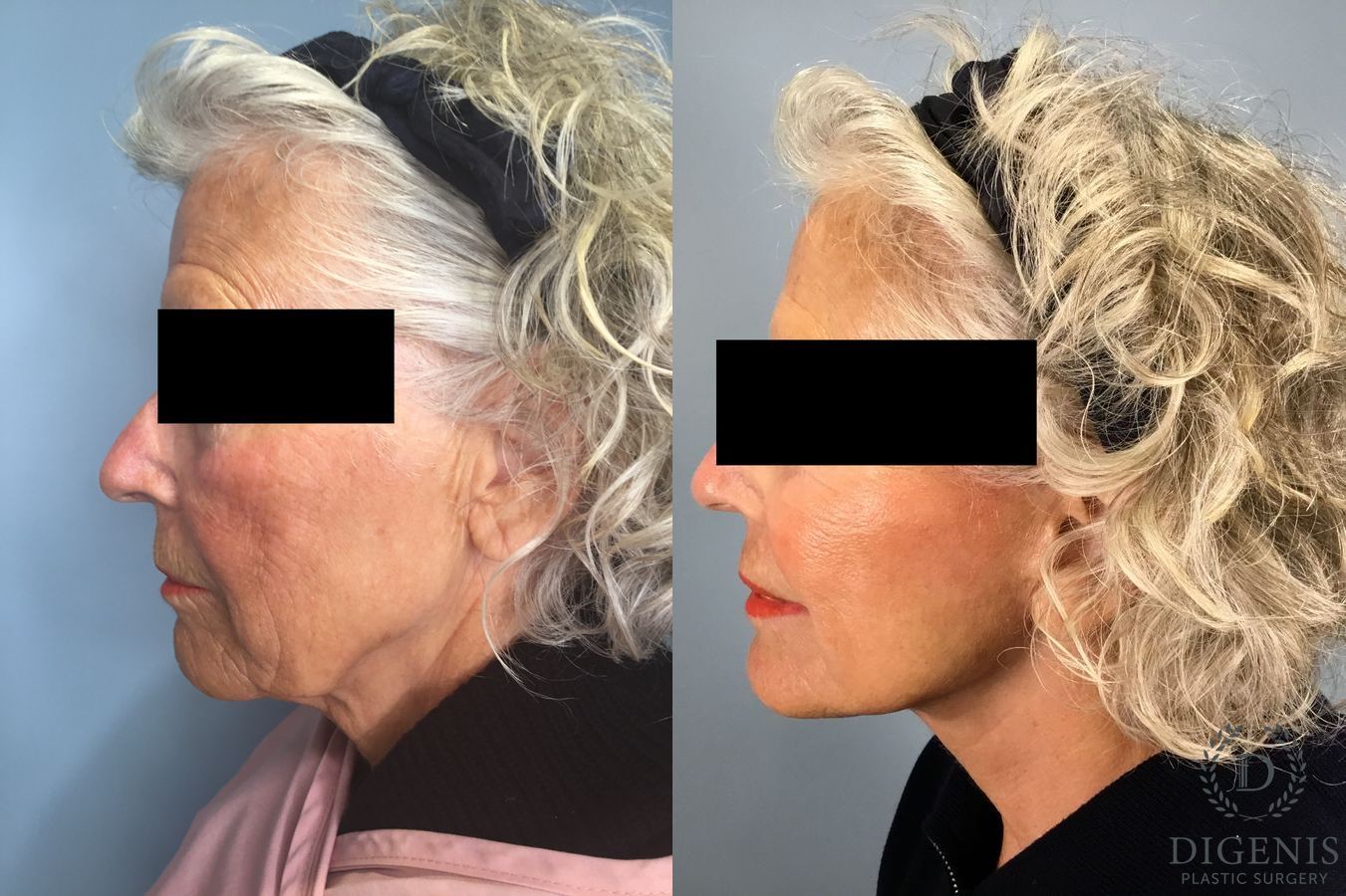 Before and after Face Lift/Neck Lift case 41357 - Angle 2