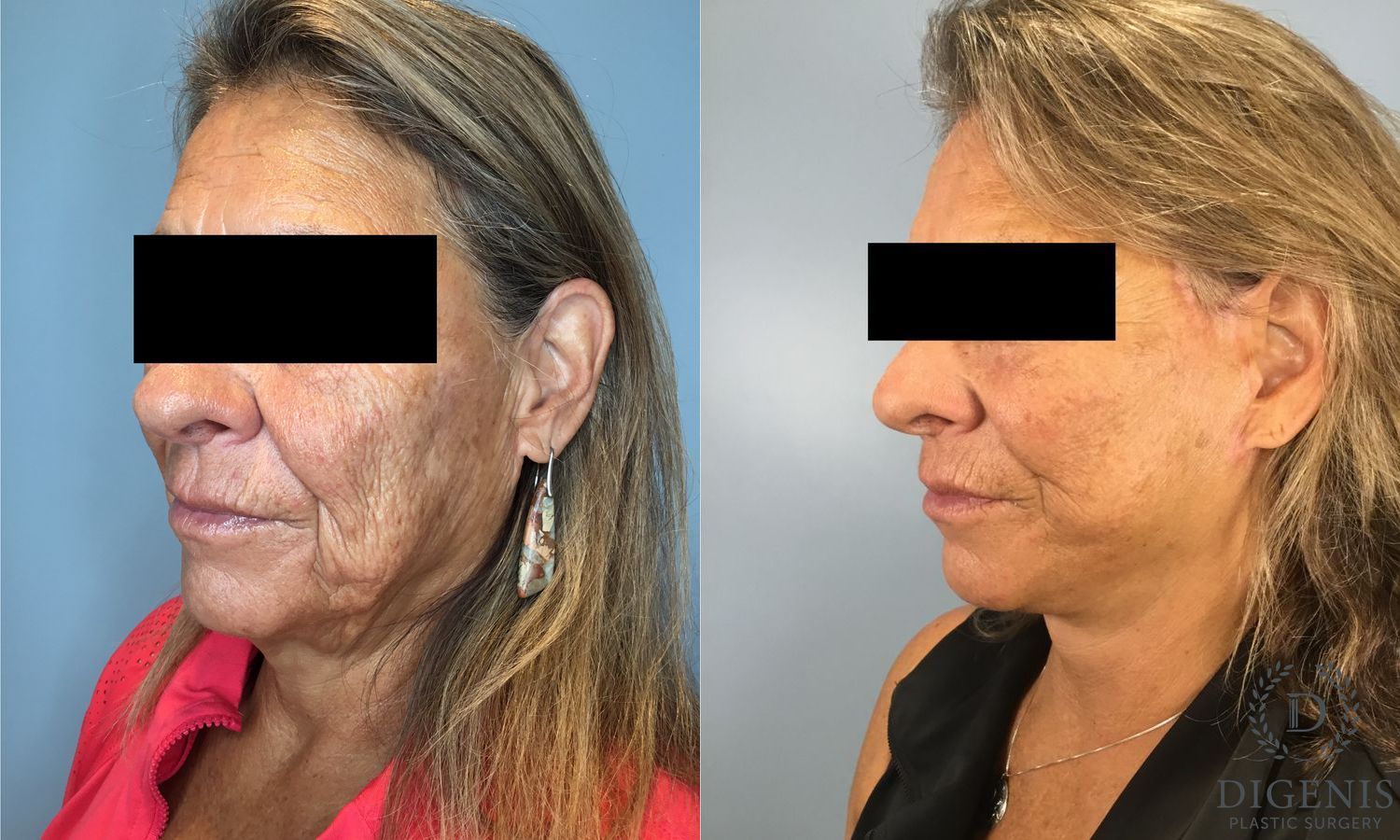 Before and after Face Lift/Neck Lift case 41925 - Angle 3