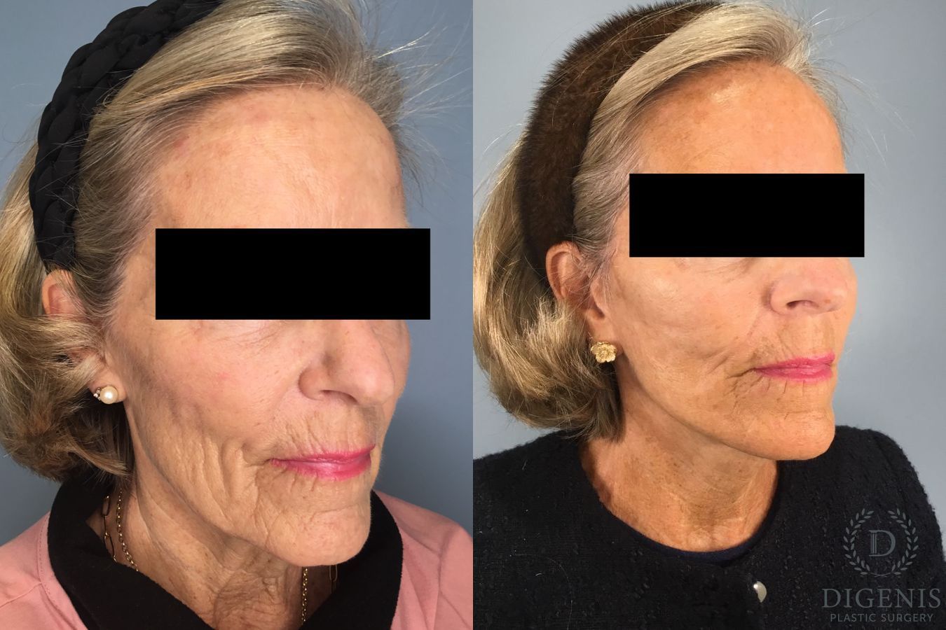 Before and after Face Lift/Neck Lift case 41847 - Angle 3